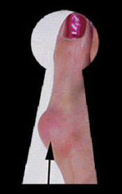 keyhole bunion surgery