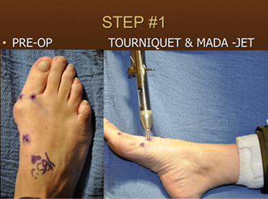 keyhole bunion surgery