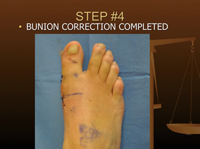 keyhole bunion surgery